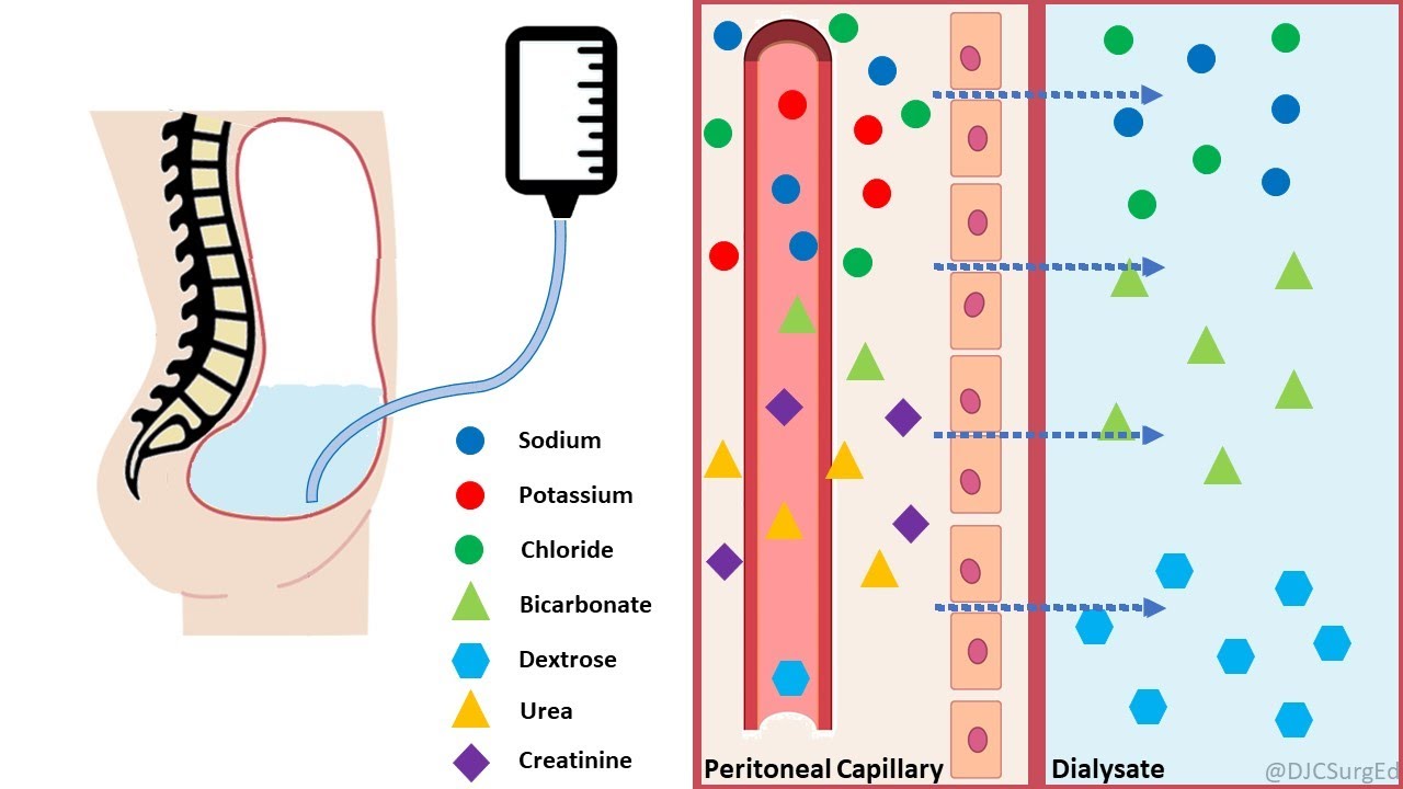 Peritoneal Dialysis