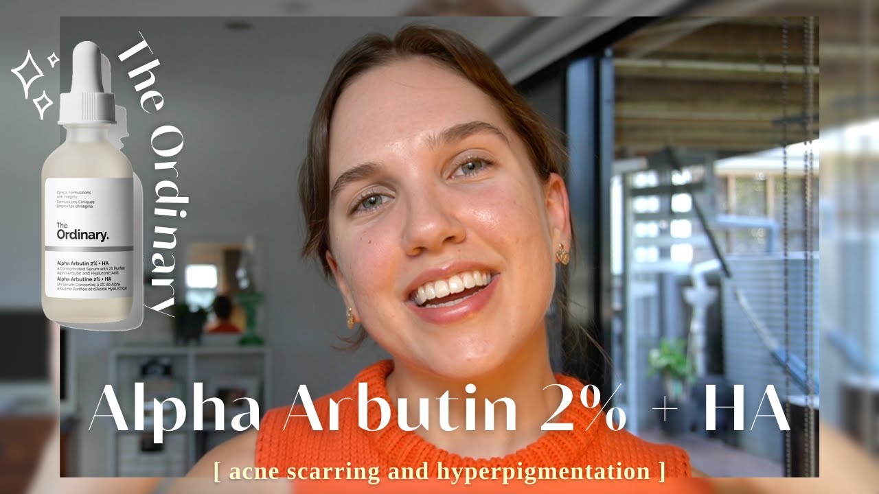 Using The Ordinary Alpha Arbutin 2% + HA For 30 Days | Before and After Hyperpigmentation