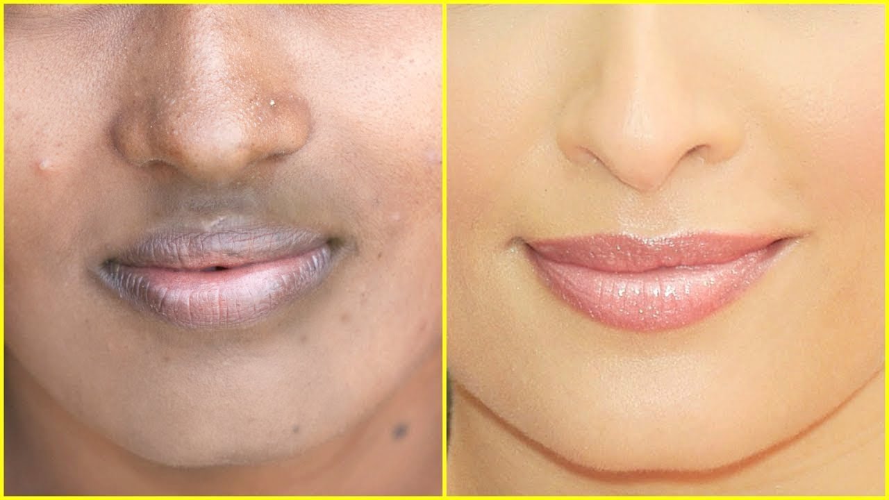 In Just 7 Days - Remove DARK SPOTS, ACNE SCARS & BLACK SPOTS |Anaysa