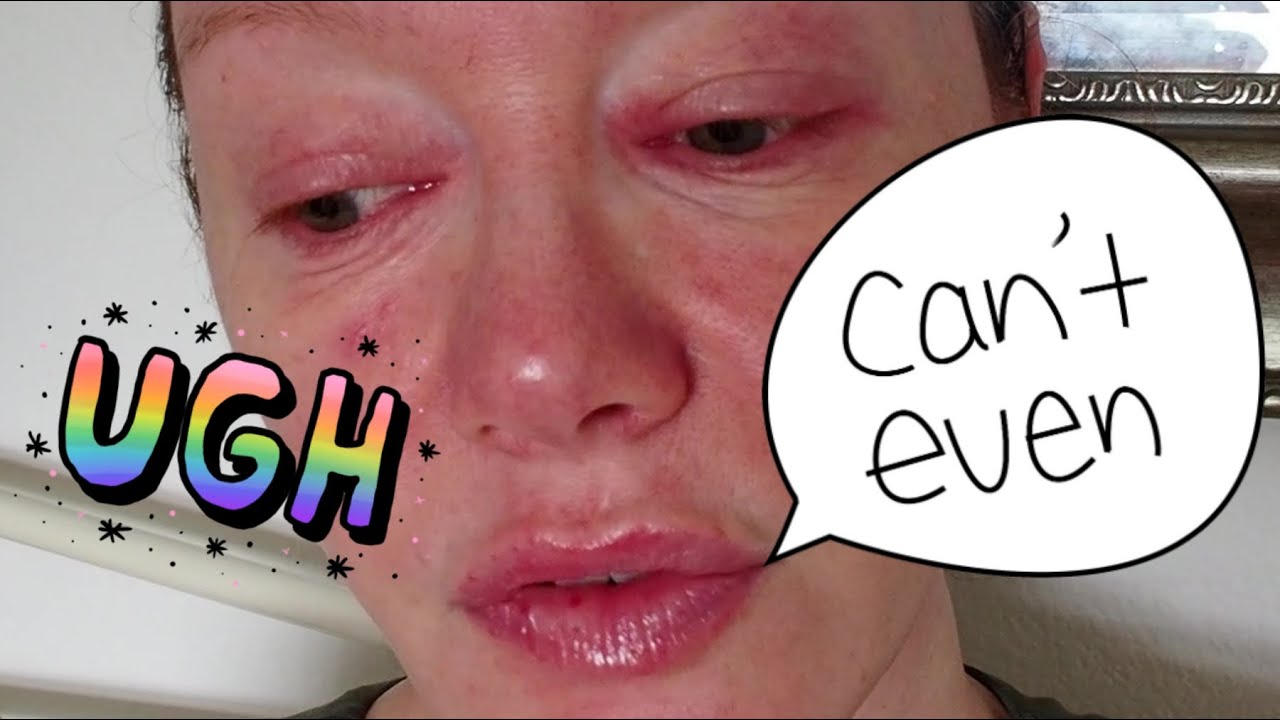 Peri Menopause | Rosacea | Blepharitis | Eczema - Struggling (AGAIN!) Today