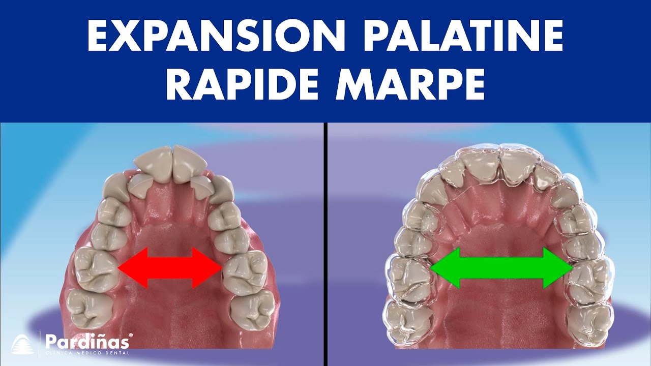 Expansion palatine rapide (MARPE) - DISJONCTEUR ORTHODONTIQUE chez l'adulte ©