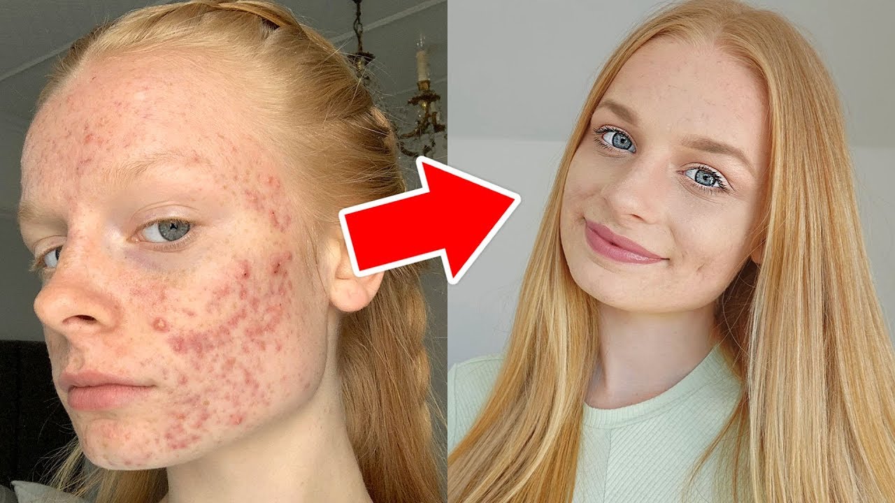 HOW I COVER MY ACNE grwm + tutorial