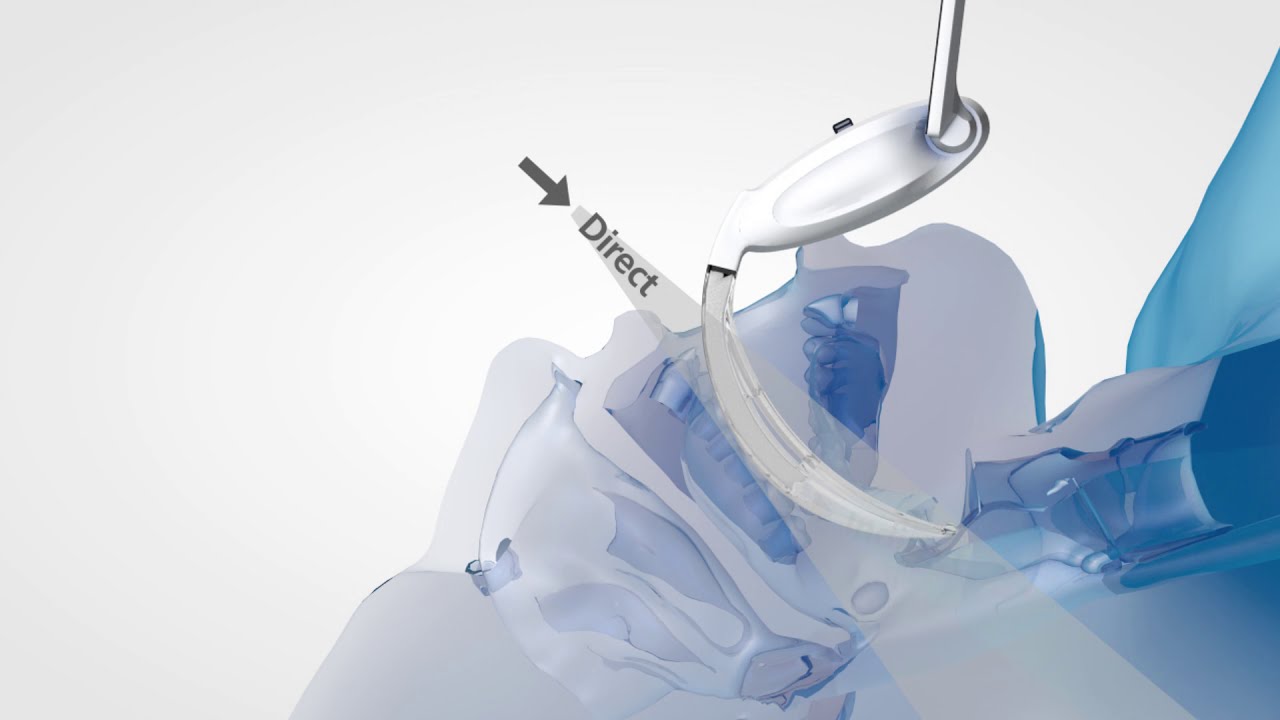 Furthering Patient Intubations with Innovative Video Laryngoscopy