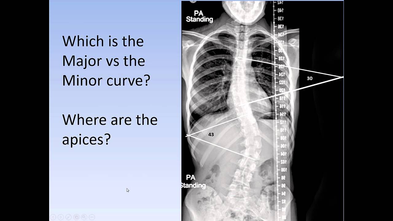 Scoliosis: How to medically classify scoliosis (the Lenke System for AIS)