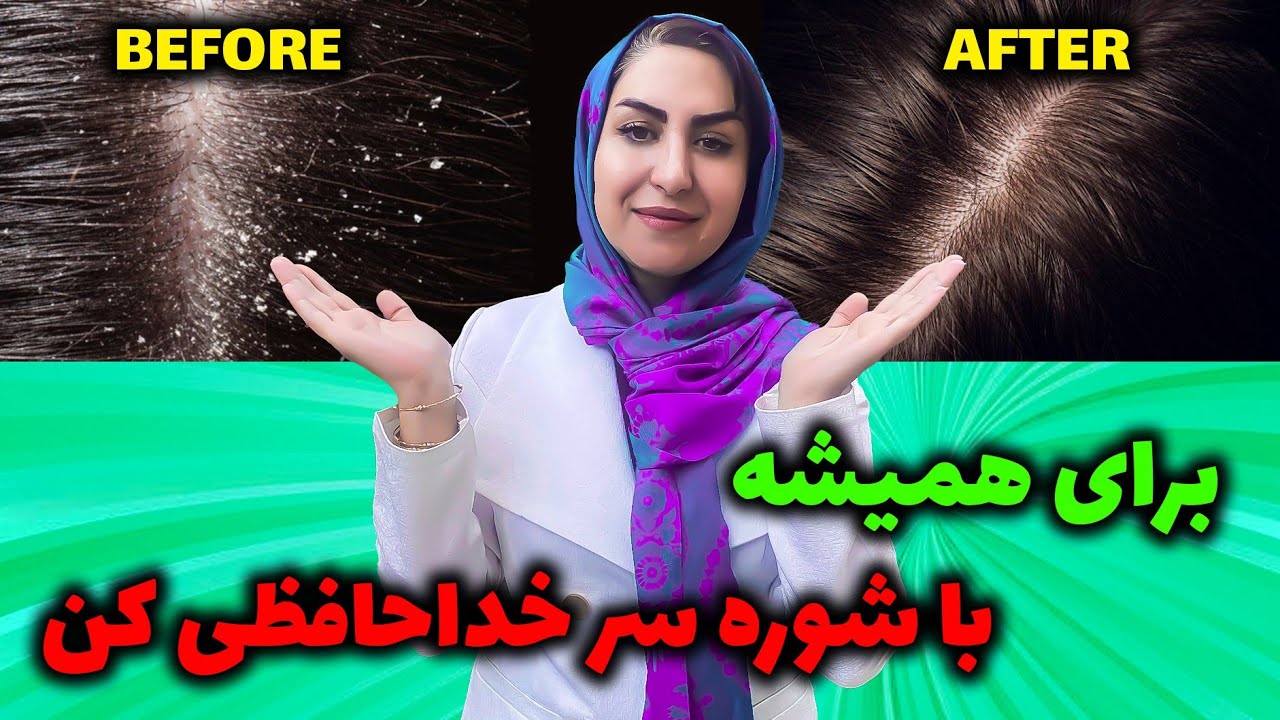 درمان شوره سر: درمان سریع و آسان شوره سر چرب و خشک با راهکارهای طبیعی 😍