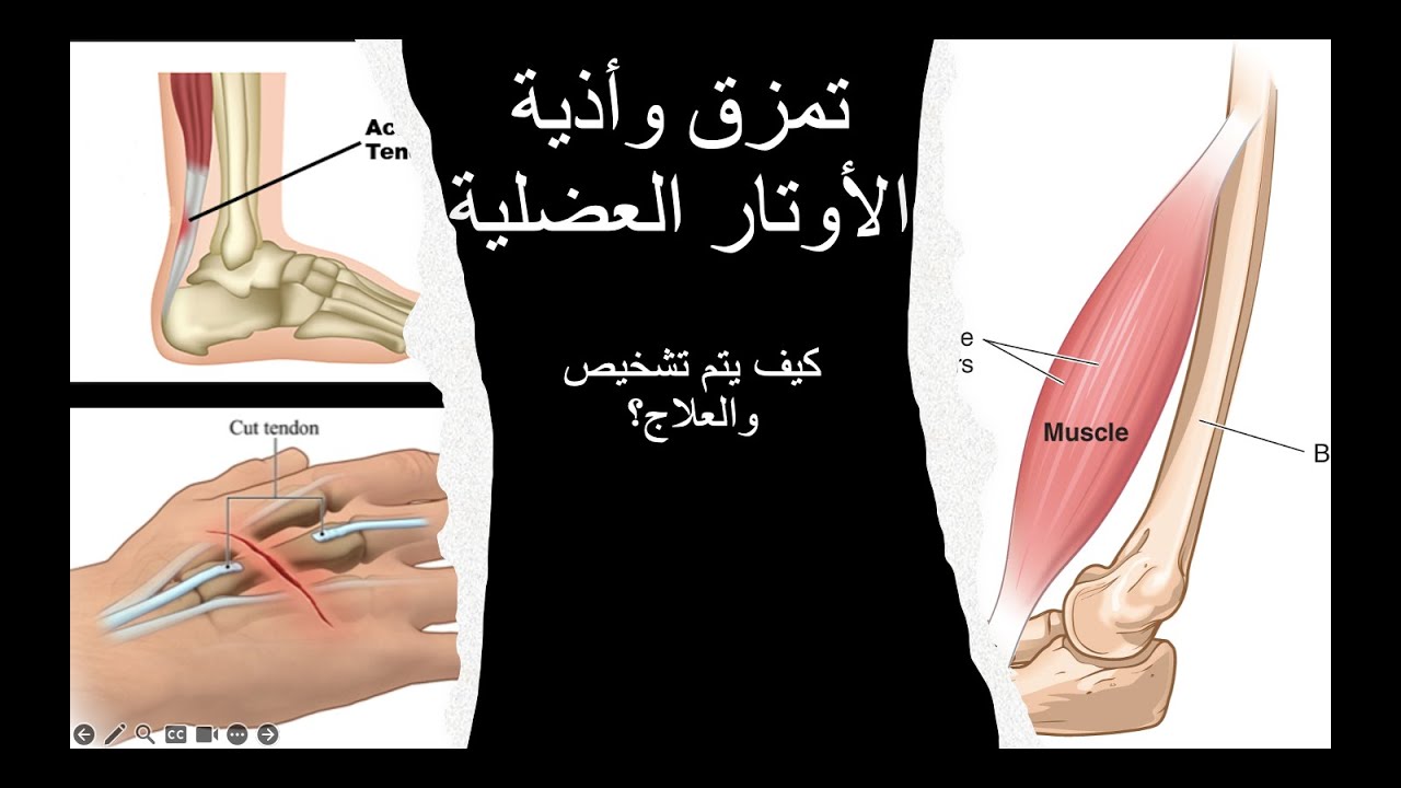 Tendons Injury /أذية الأوتار العضلية