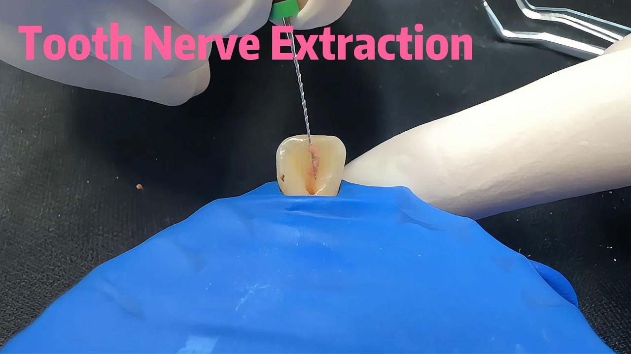 How to Save a Painful Front Tooth#RootCanal#ToothNerve #SmileMakeove#Dentistry
