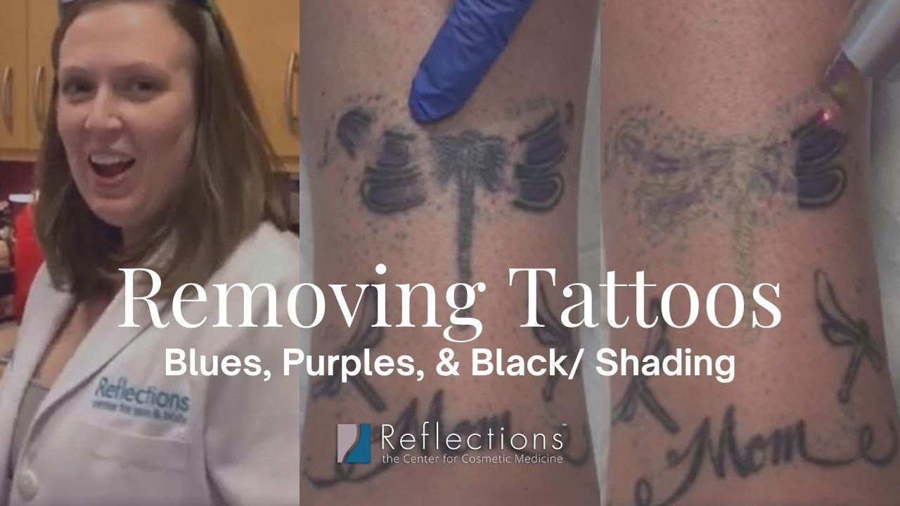 Removing Multi Colored Tattoos [ Laser Tattoo Removal ] with Dr. Michelle Ellern
