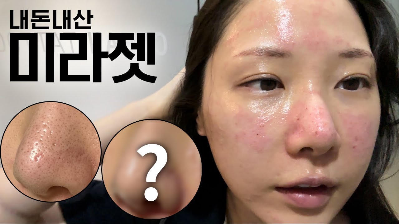 강남에서 난리난 모공치료 '미라젯'  내돈내산 3개월 리얼후기 l 코모공 여드름흉터