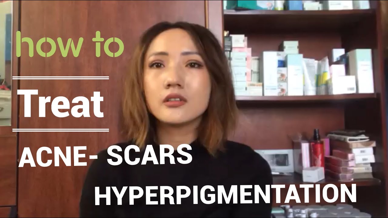 How to treat Acne Scar and Hyperpigmentation