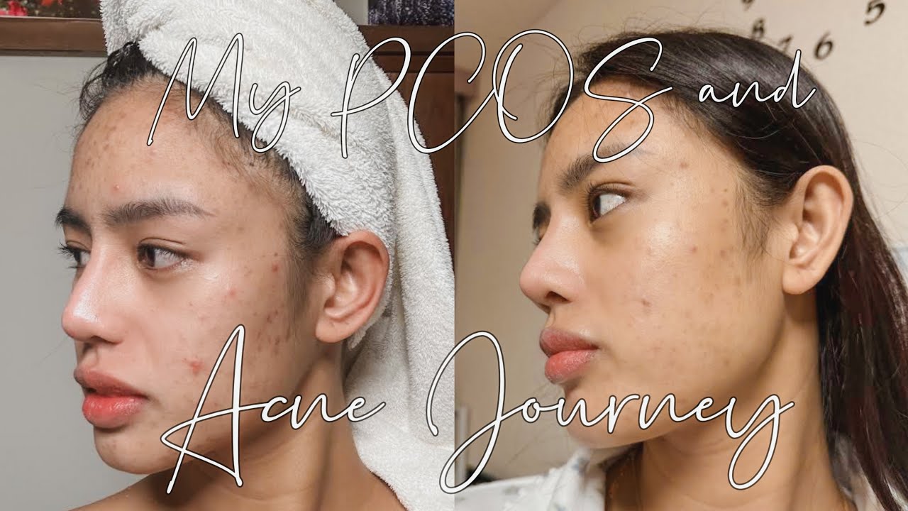 My PCOS and Acne Journey | Acne Management