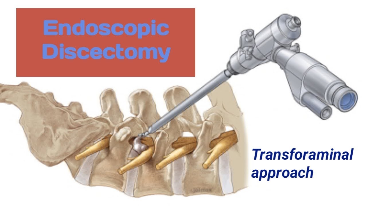 Endoscopic Discectomy (animation)