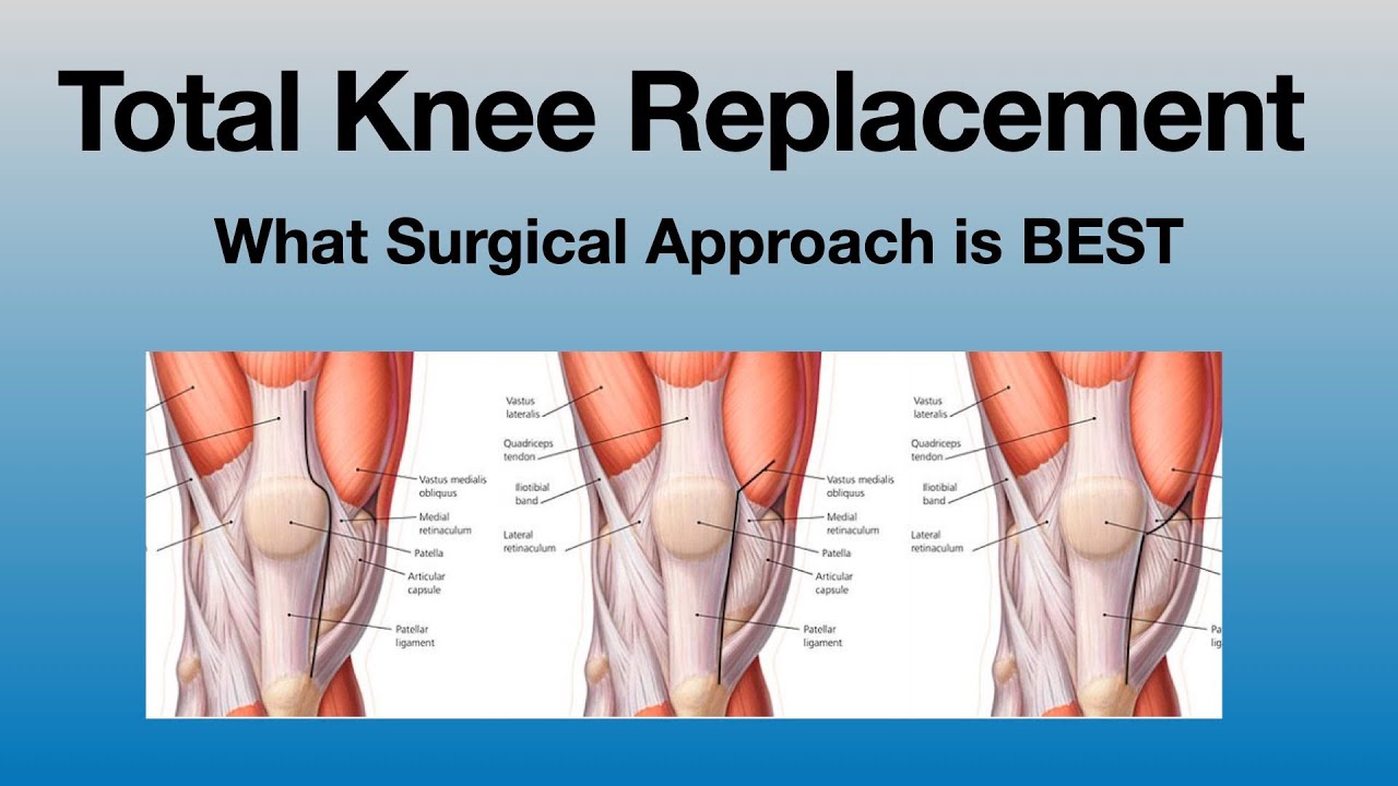 Quad-Sparing vs Traditional Knee Replacement: What to Know