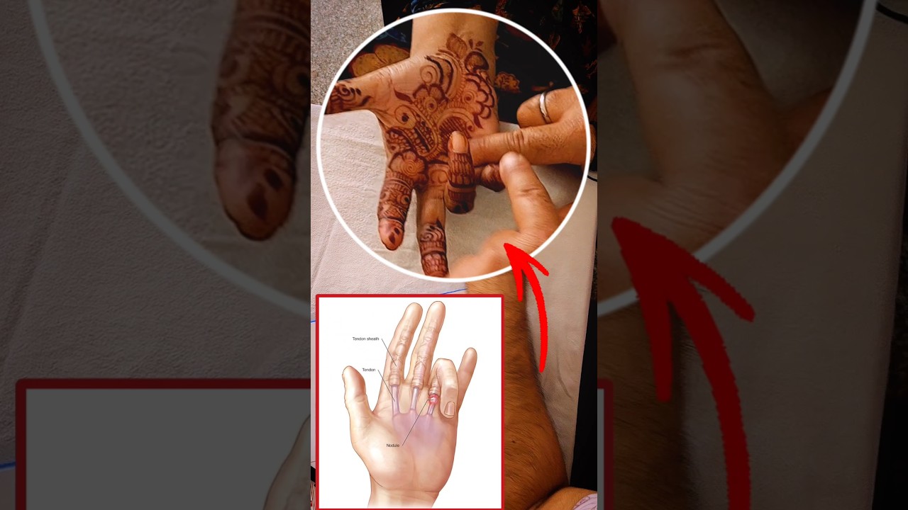 Finger Stuck? This Will SHOCK You! 😱🖐 #TriggerFinger