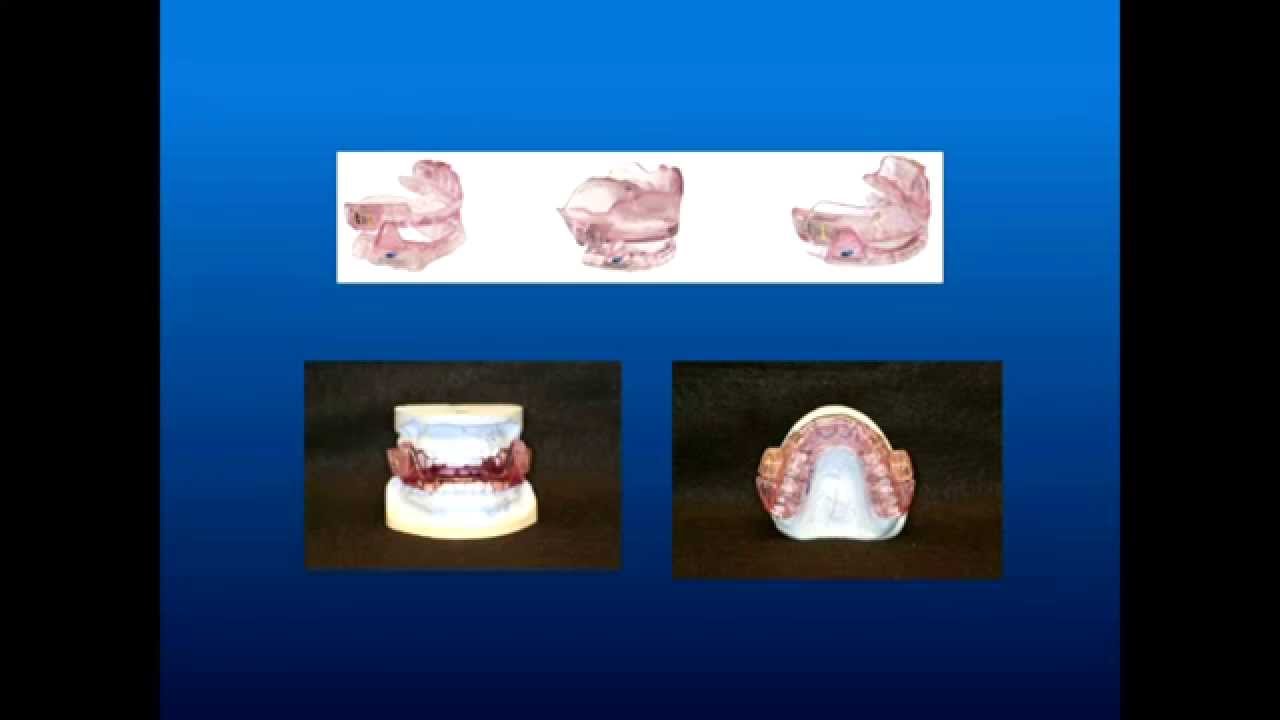 Obstructive Sleep Apnea Part 11: Oral Appliance Fabrication