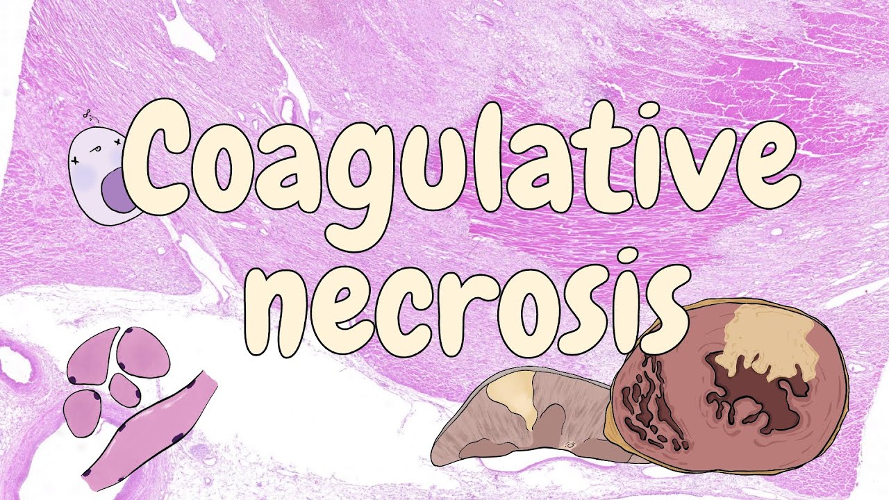 Coagulative necrosis - general pathology