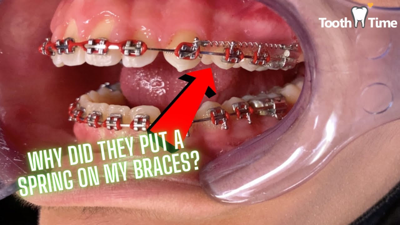 Why did they put a spring on my braces? Dental Coil Springs - Tooth Time Family  New Braunfels