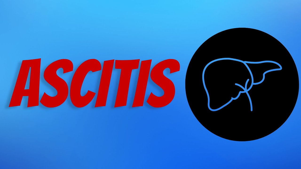 Ascitis
