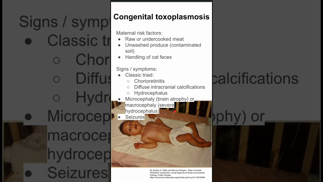 Congenital toxoplasmosis
