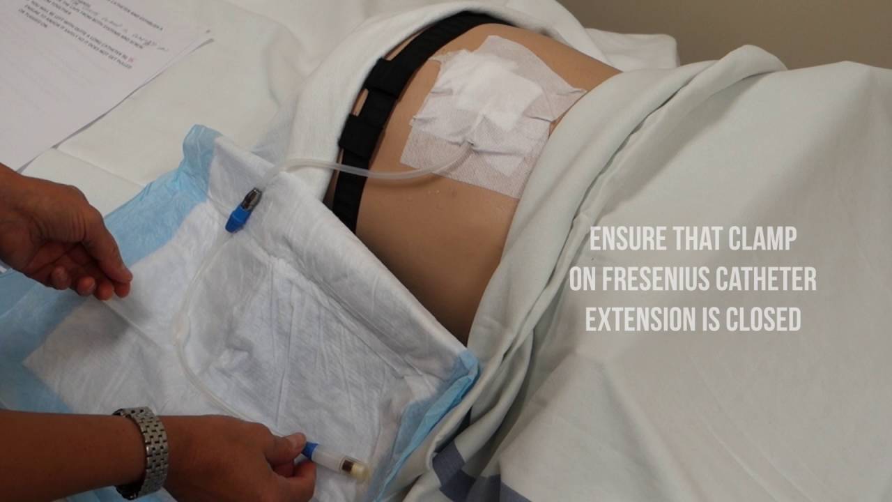 PART 2 - How to attach a Baxter transfer set to a Fresenius C.A.P.D. catheter