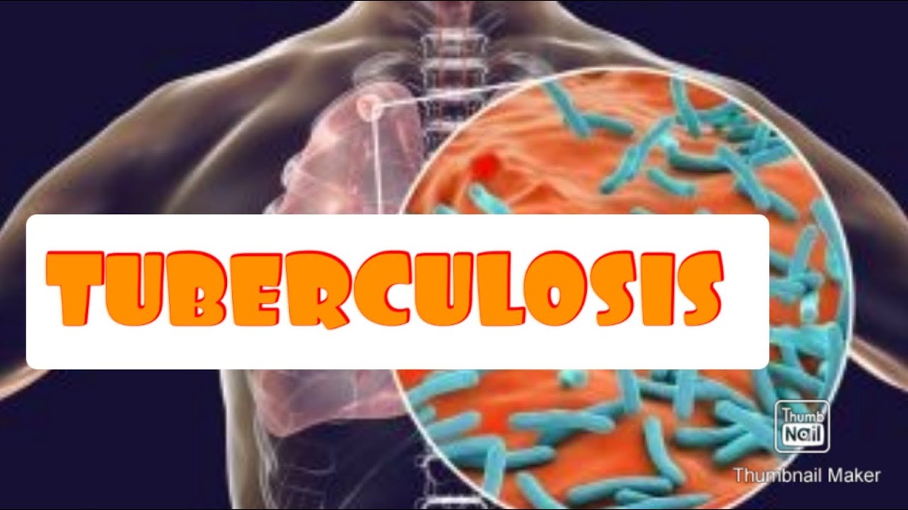 ТУБЕРКУЛОЗА