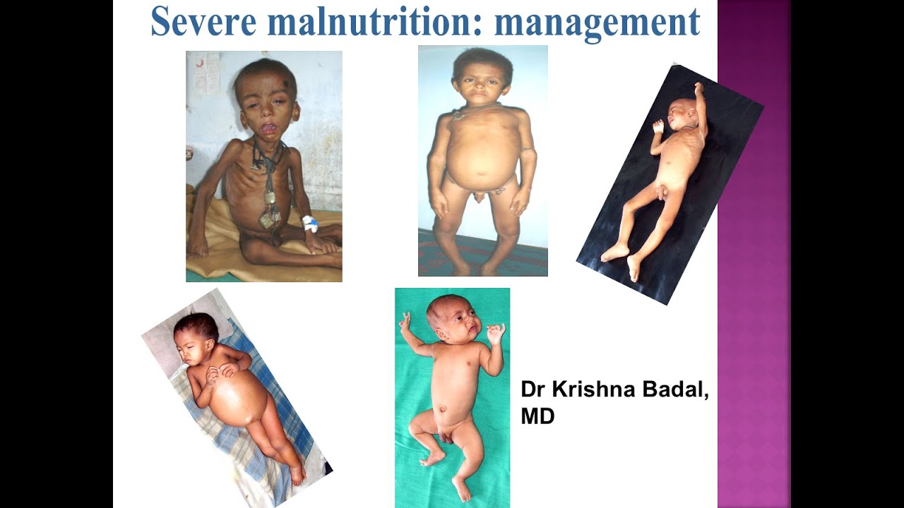 Management of severe malnutrition