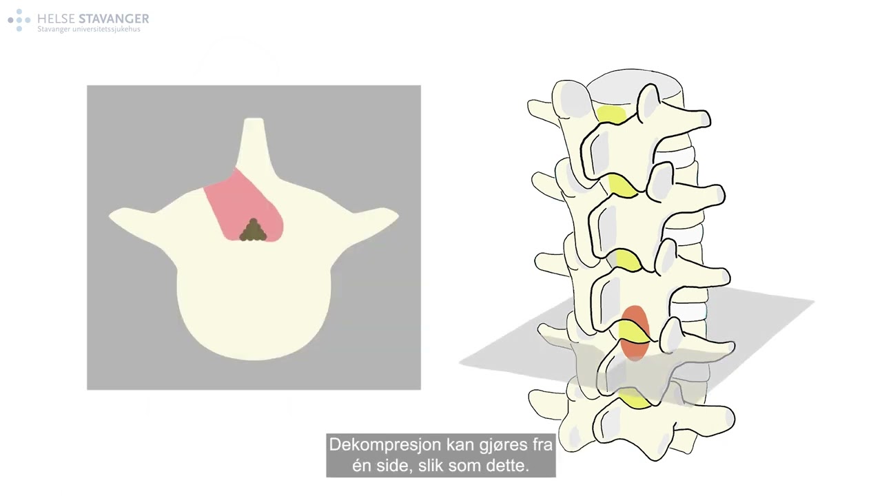Spinal stenose