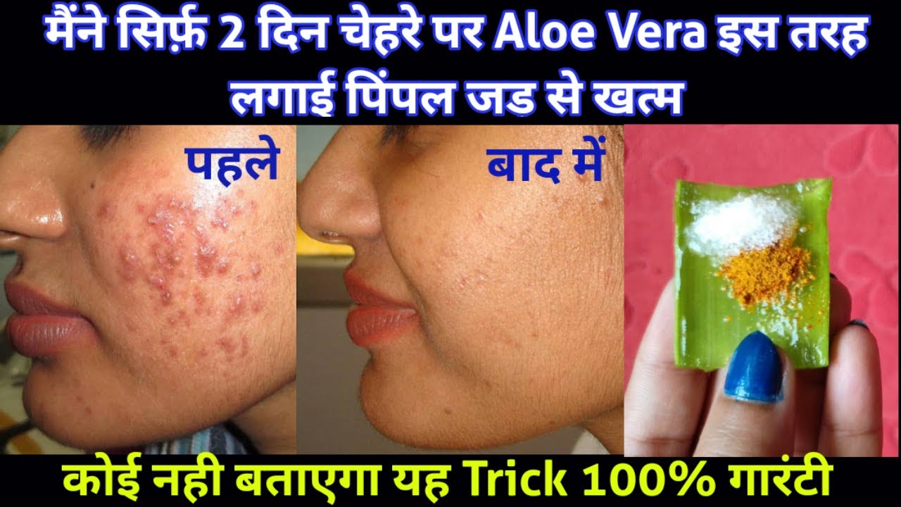 मैंने सिर्फ 2 दिन चेहरे पर यह लगाया सारे Pimples जड़ से खतम, चेहरा गोरा हो गया How to Remove Pimples