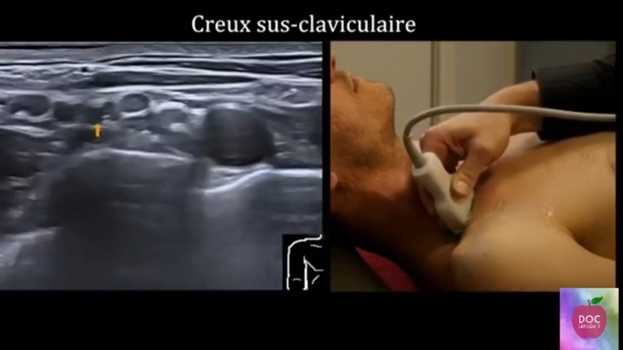 Echographie du plexus brachial