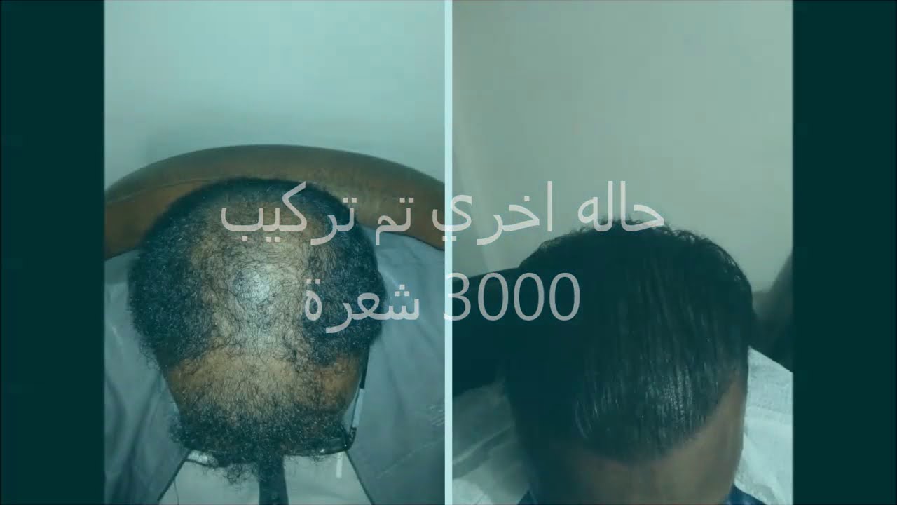 زراعة الشعر الايطالي 