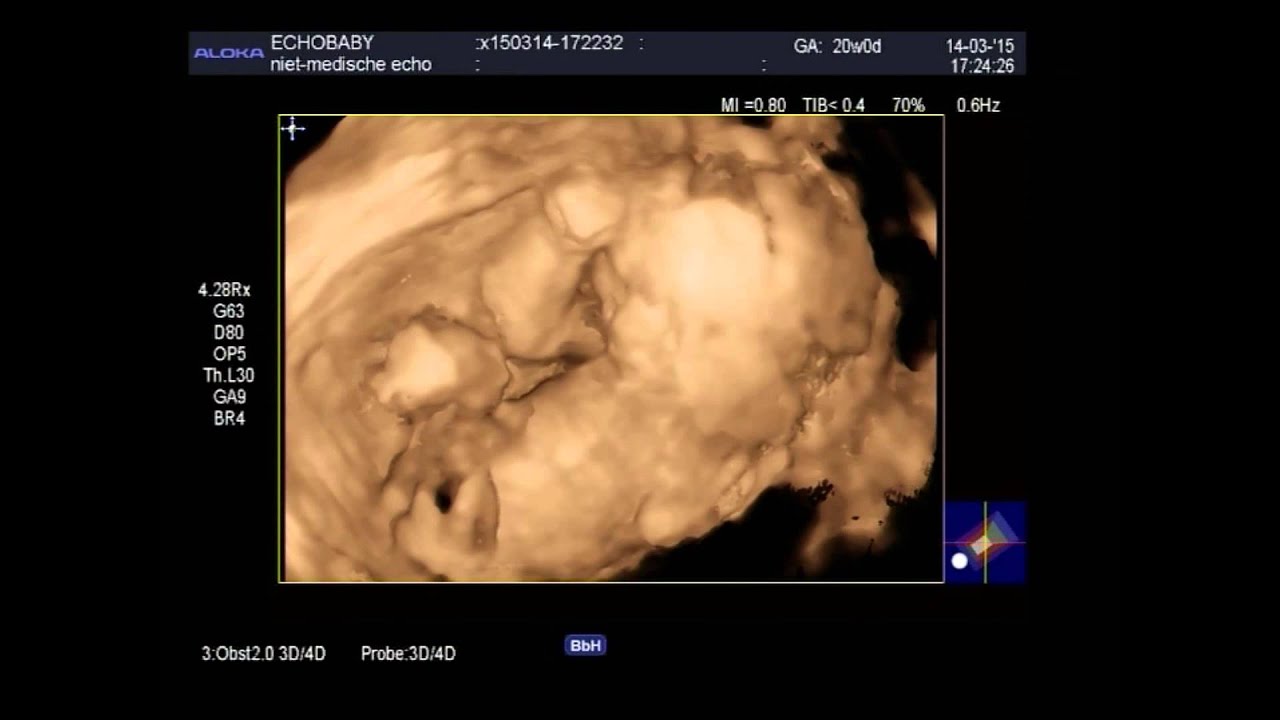 3D echo 20 weken zwanger