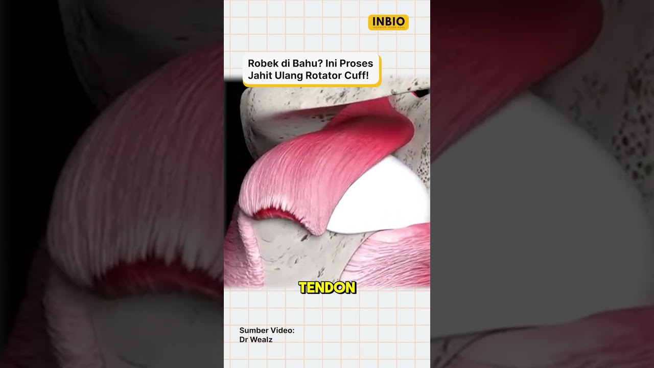 Robek di Bahu? Ini Proses Jahit Ulang Rotator Cuff!