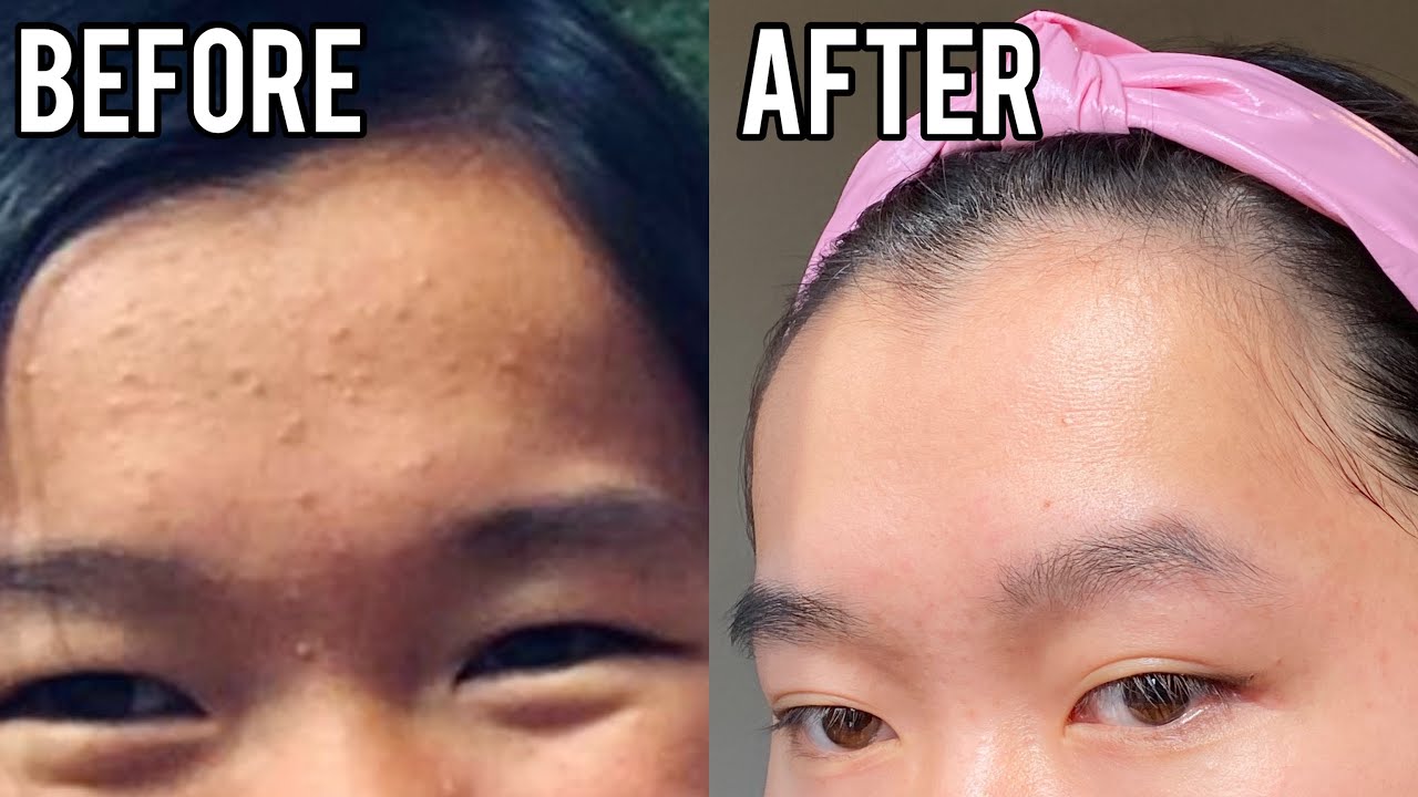 clear FOREHEAD acne/ texture FAST. use this SECRET acne product! clear fungal acne&forehead bumps