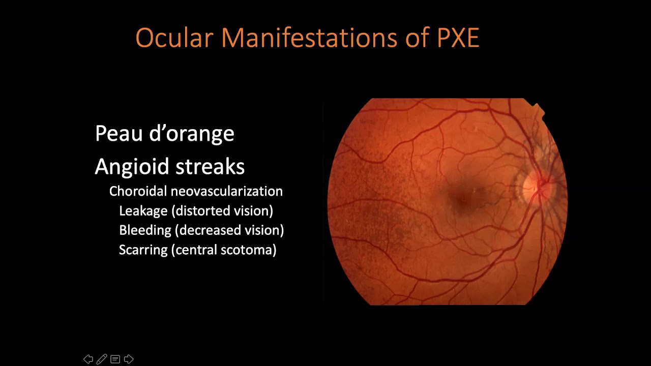 PXE International Virtual Conference 2020: PXE and the Eye