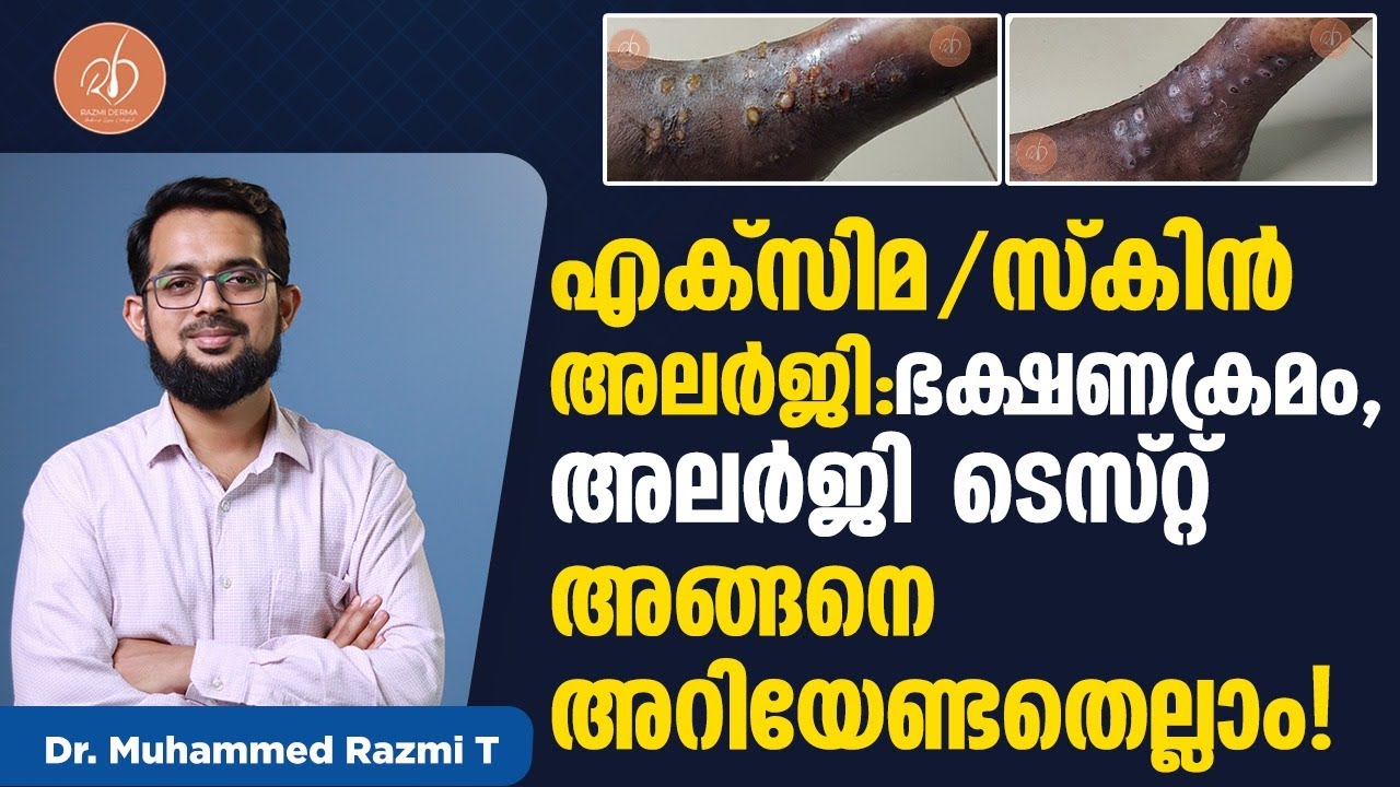 എക്സിമ/സ്കിൻ അലർജി : ഭക്ഷണക്രമം/അലർജി ടെസ്റ്റ് അങ്ങനെ അറിയേണ്ടതെല്ലാം | Eczema treatment malayalam