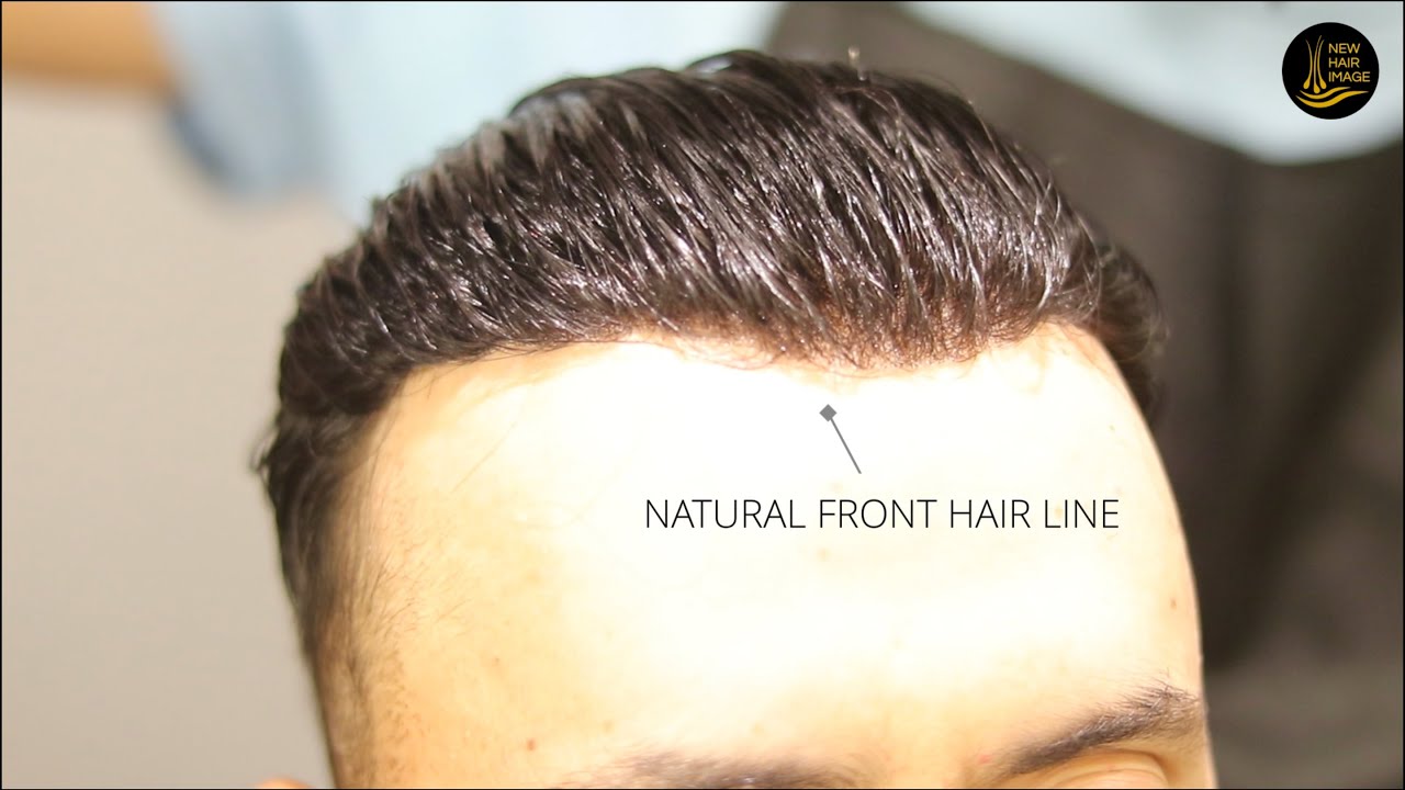 Hair Patches for men: Undetectable Front Hair line by New Hair image