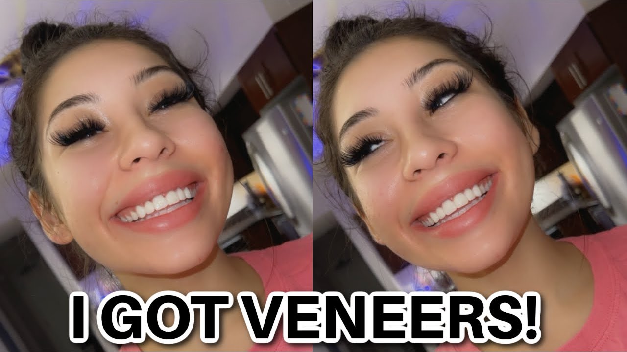 VLOG: I GOT PORCELAIN VENEERS!