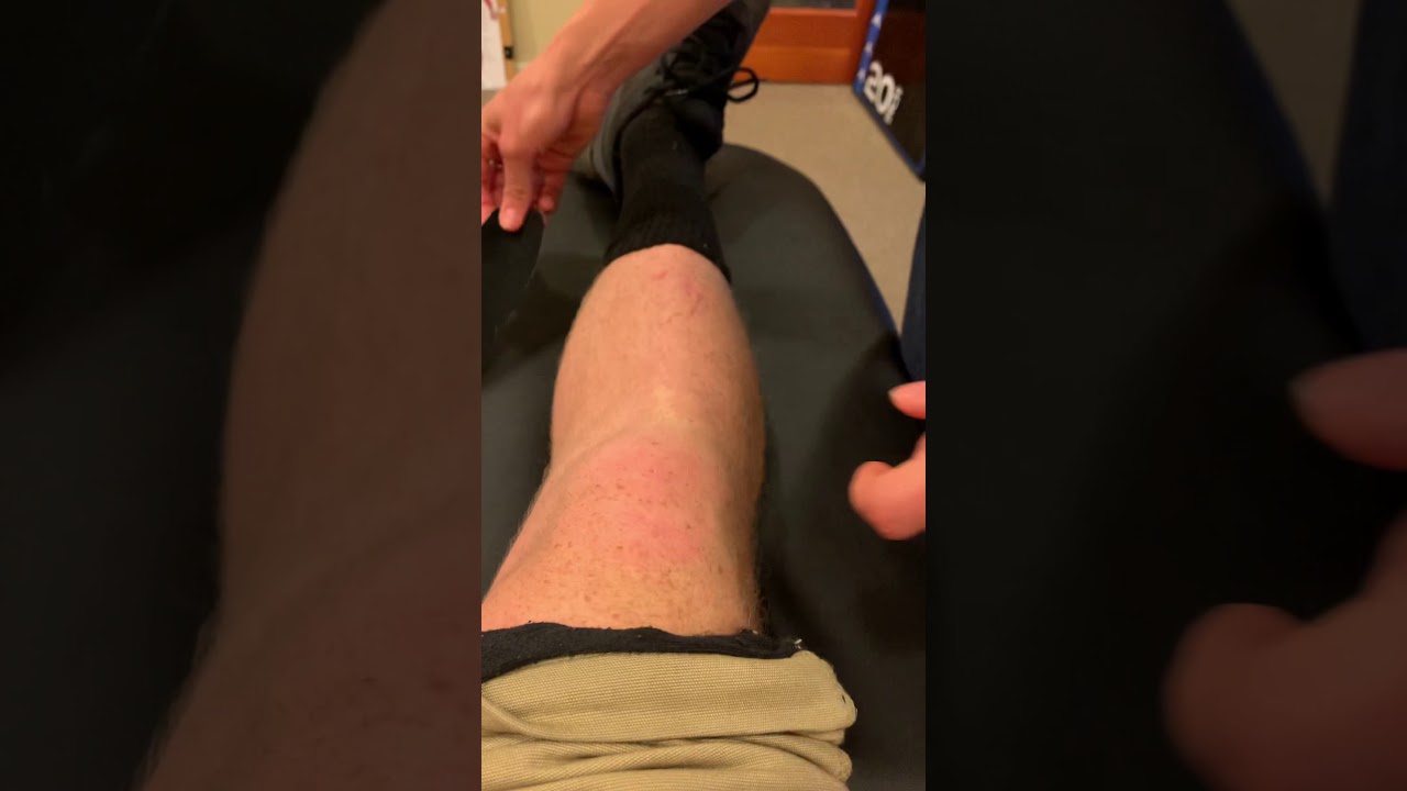 KT tape for patellar tracking