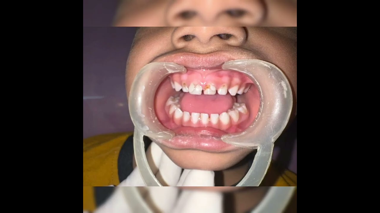 Strip Crowns in Pediatric Dentistry