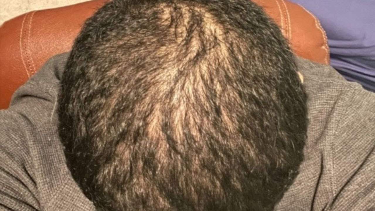 Telogen Effluvium Hair Loss: Symptoms, Causes, Treatment