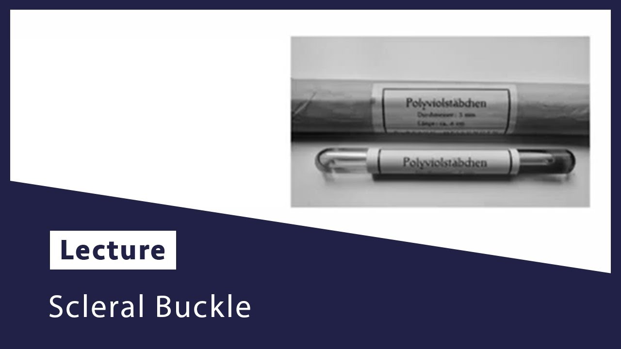 Scleral Buckle