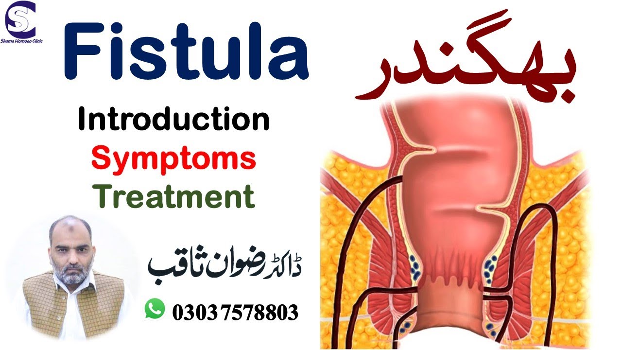 Fistula || بھگندر || Introduction, Symptoms and Treatment || By Dr. Rizwan Saqib || In Urdu/Hindi