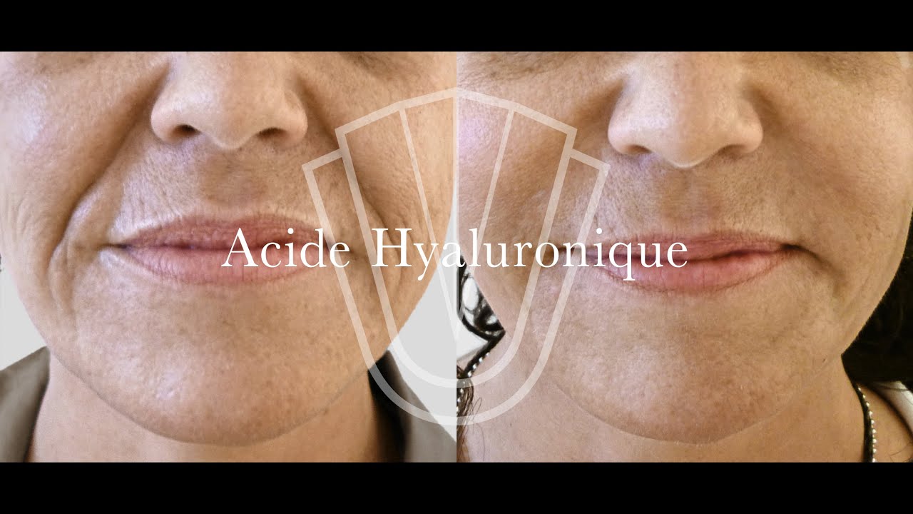 Acide Hyaluronique - Clinique Bellefontaine Lausanne