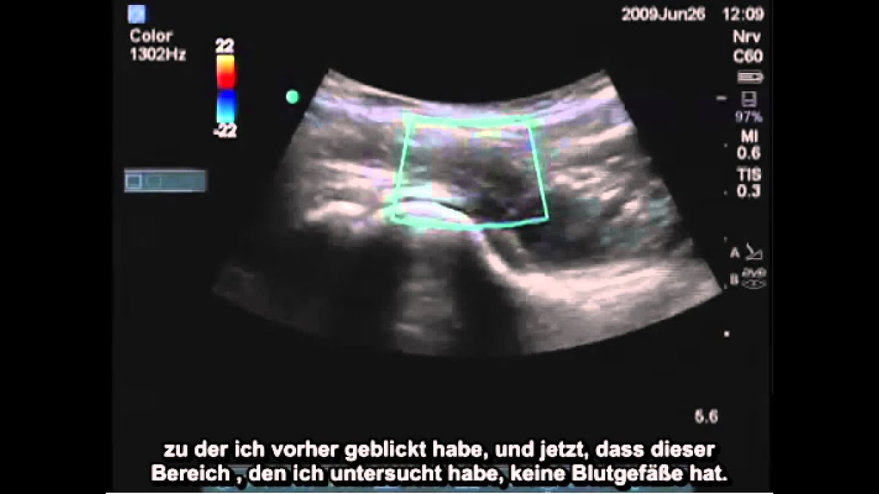 Anleitung: Ultraschalluntersuchung der Hüfte