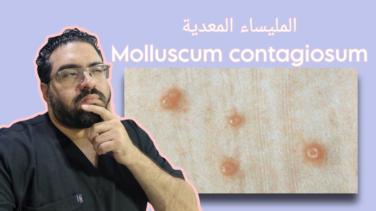 عيادة الجلدية - حلقة ٩ - المليساء المعدية(Molluscum contagiosum)