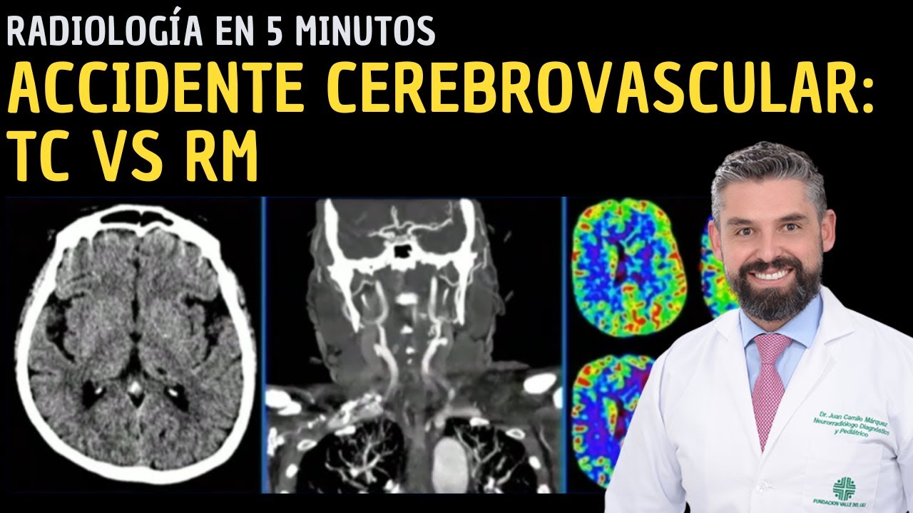 Radiología en 5 minutos: Accidente cerebrovascular: Tomografía computarizada vs Resonancia magnética