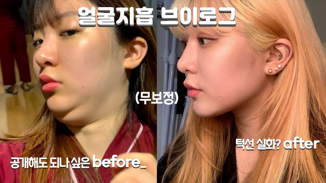 얼굴 지방흡입 브이로그 | 일주일에서 다섯달차 후기까지