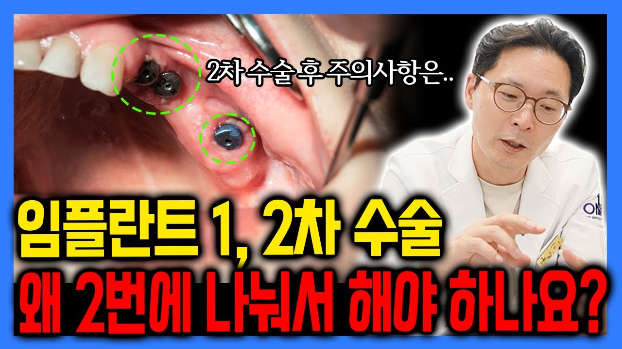 임플란트 수술을 2번 나누는 이유와 주의 사항은?