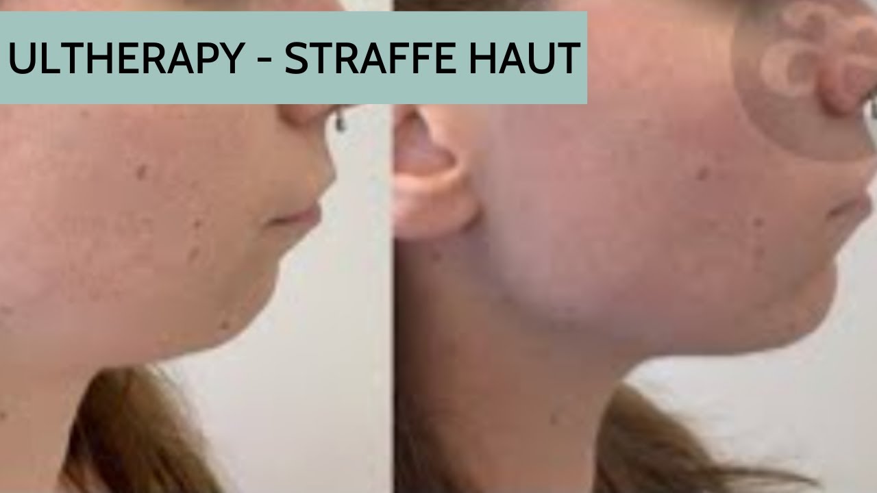 ULTHERAPY® - Straffe Haut mit HiFu Ultraschall im Gesicht, Décolleté und Körper - DR. KATRIN BARTSCH