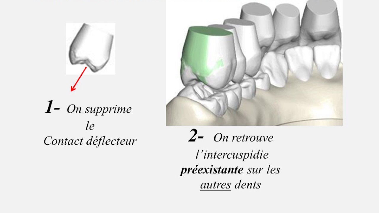 normalité d'une occlusion
